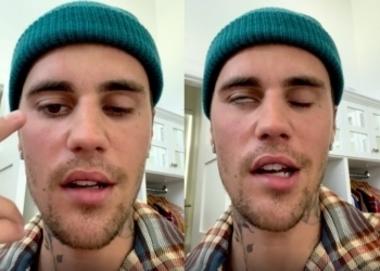 Che Malattia Ha Justin Bieber